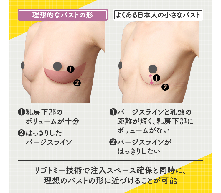 日本人 偽物豊胸改造おっぱい 