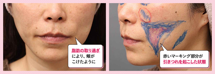 顔の脂肪吸引で失敗して頬がコケてしまった症例