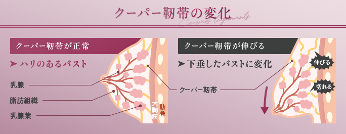 クーパー靭帯の変化