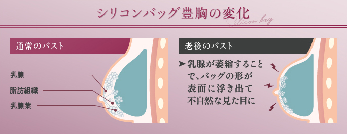 シリコンバッグ豊胸の変化