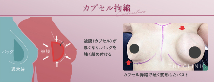 シリコンバッグ豊胸のカプセル拘縮