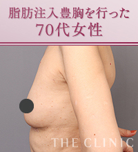 脂肪注入豊胸を行った70代女性