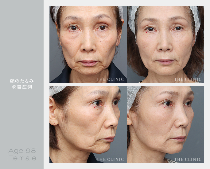 68歳女性の顔のたるみを改善した脂肪注入の症例