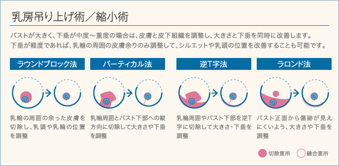 THE CLINICが行う乳房吊り上げ術/縮小術の4つの術式