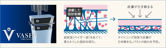 ベイザー脂肪吸引は術後に皮膚が引き締まる仕組み