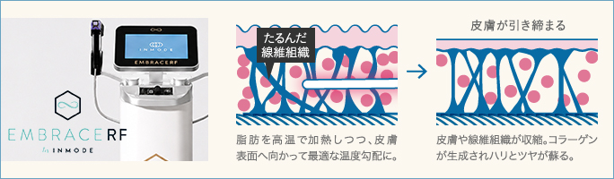 皮膚のたるみを強力に引き締めて胸を小さく見せるRFタイトニング