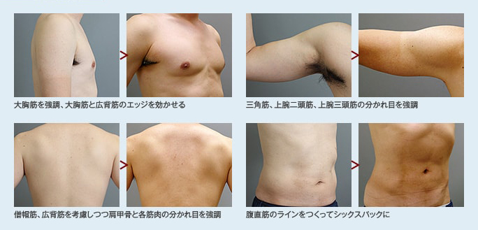 ドクターが受けた脂肪吸引の効果