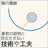乳房縮小術の胸の傷跡について、事前の説明と目立たせない技術や工夫で対応