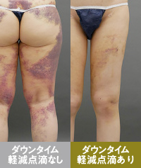 太もも脂肪吸引の際にダウンタイム軽減点滴を行っていないケースと行ったケースの内出血の程度の違い