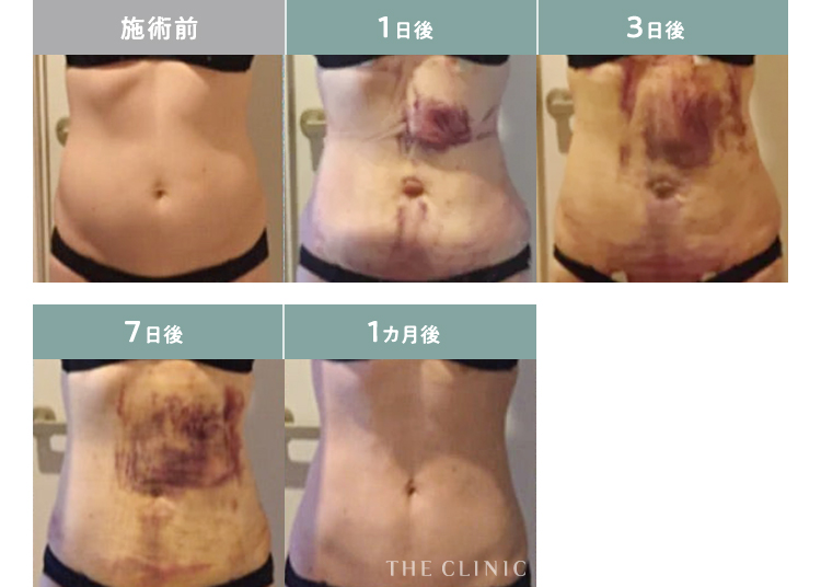脂肪吸引のダウンタイム〜辛い・痛いを早く治す方法〜