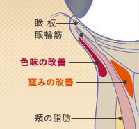 脂肪注入による脱脂の失敗治療は症状によって注入する層が違う