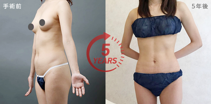 お腹脂肪吸引5年後の症例