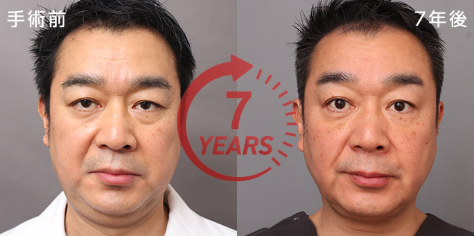 顔の脂肪吸引から5年経過した症例写真