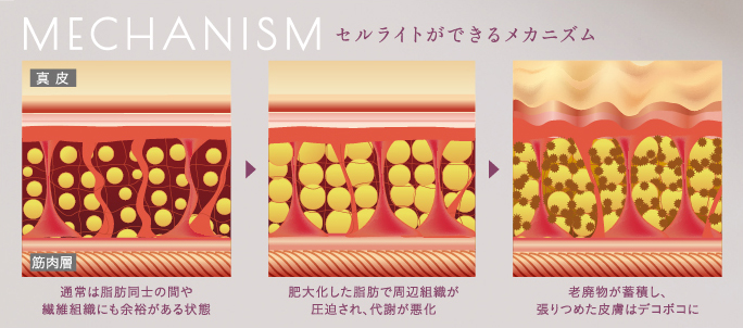 セルライトができるメカニズム