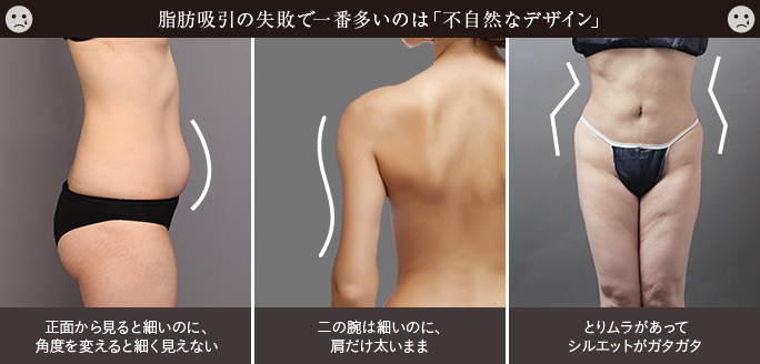 脂肪吸引の失敗原因