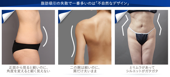 脂肪吸引でよくある失敗