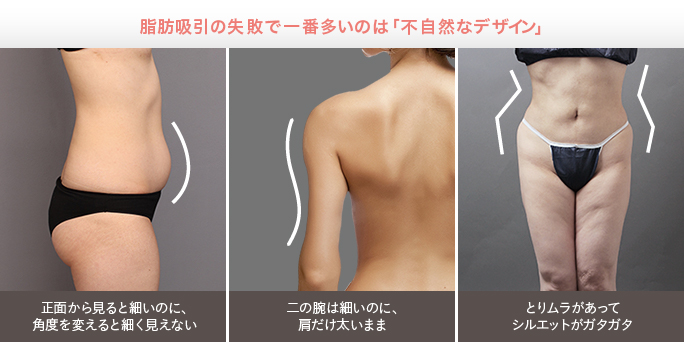 脂肪吸引の失敗原因