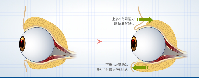 目の下が膨らむ要因