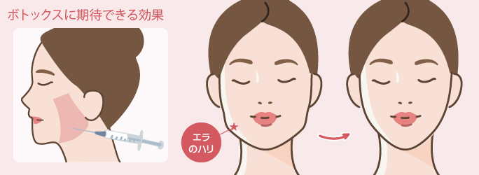 ボトックスに期待できる効果