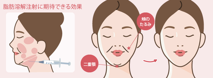 脂肪溶解注射に期待できる効果