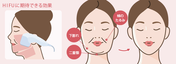 ハイフに期待できる効果