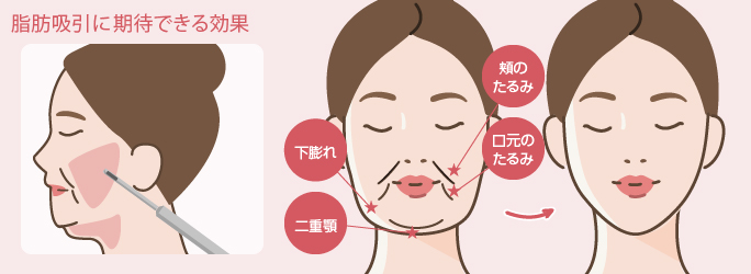 脂肪吸引に期待できる効果