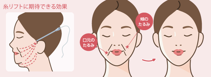糸リフトに期待できる効果