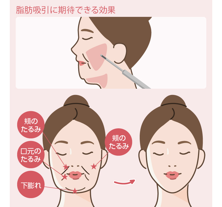 顔痩せ・小顔に効果的な筋トレ、マッサージ、美容施術