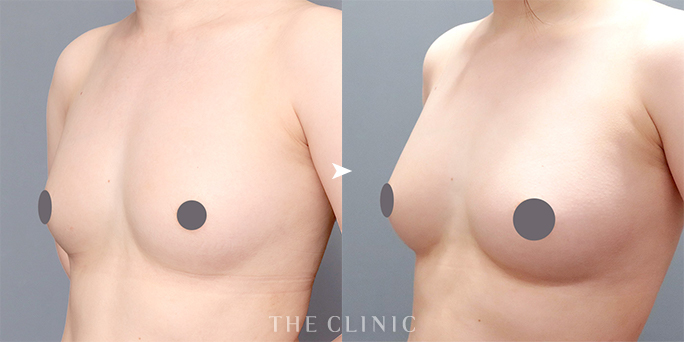 脂肪注入で下乳ラインがくっきりした症例