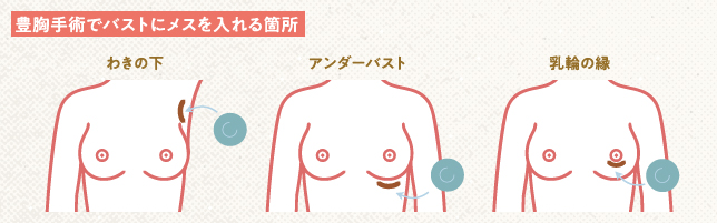 豊胸手術でバストにメスを入れる箇所