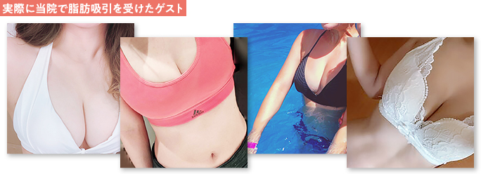 当院で脂肪吸引を受けたゲスト