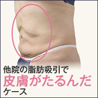 脂肪吸引の失敗で皮膚がたるんだお腹