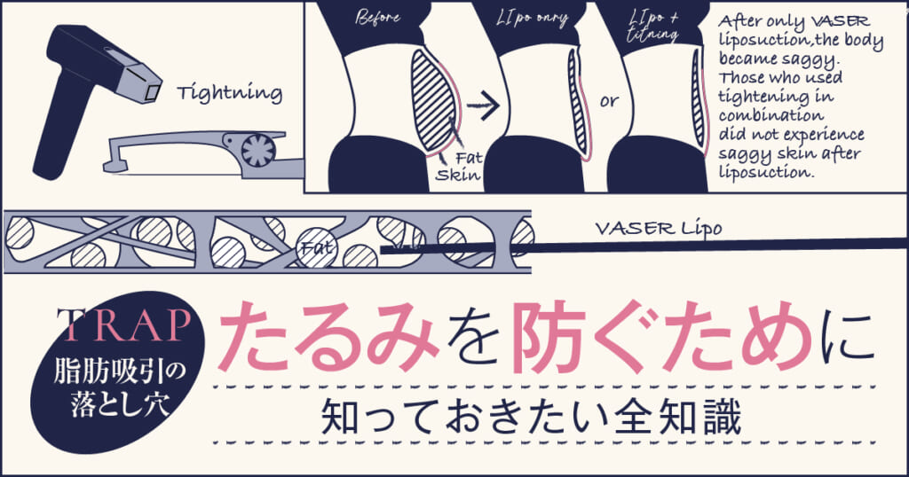脂肪吸引の落とし穴｜たるみを防ぐために知っておきたい全知識
