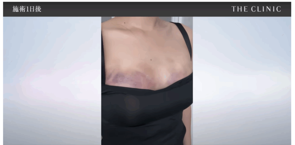 脂肪豊胸後1週間の写真