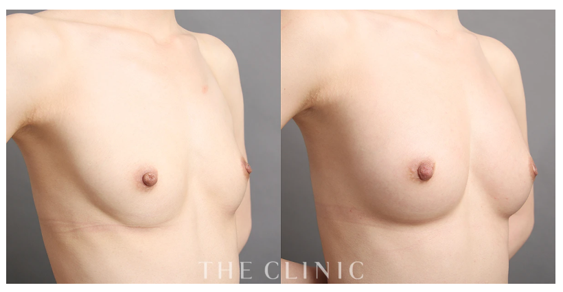 脂肪注入豊胸の症例