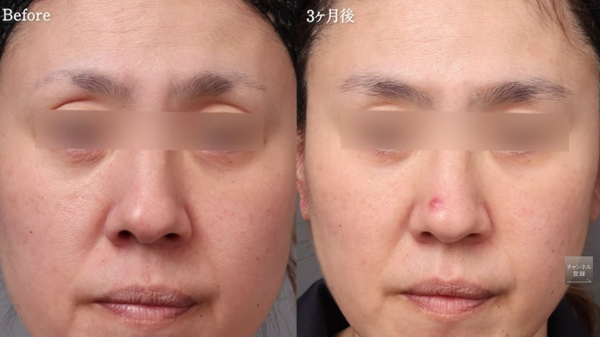 目の下のクマ取り失敗修正の症例