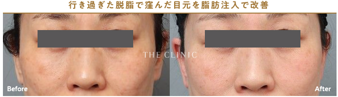 【症例】行き過ぎた脱脂でくぼんだ目元を脂肪注入で改善