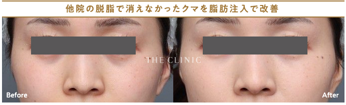 【症例】他院の脱脂で消えなかったクマを脱脂注入で改善