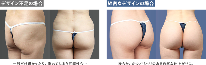デザインせずに脂肪吸引に失敗したお尻と、緻密なデザインで脂肪吸引してキレイに仕上がったお尻