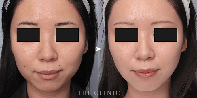 顔の脂肪吸引でフェイスラインをスッキリさせた20代女性のビフォーアフター