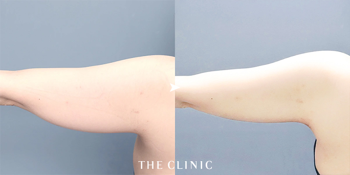 30代女性の二の腕脂肪吸引のビフォーアフター