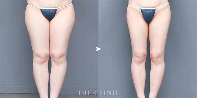 脚が細く長く見えるようデザインされた太もも脂肪吸引のビフォーアフター