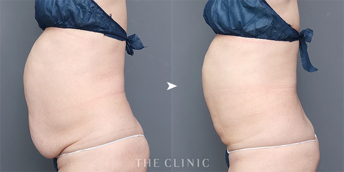 お腹のつかえるぜい肉を解消した50代女性の脂肪吸引の症例