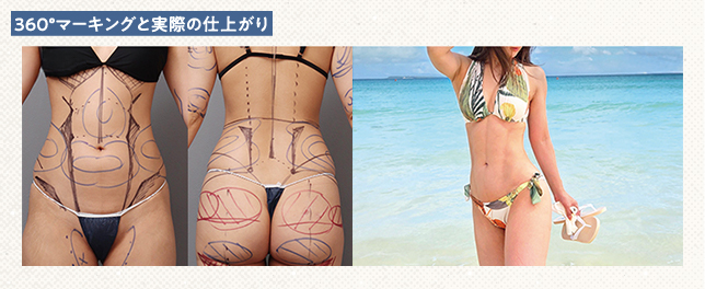 360°マーキングを施したお腹・腰・お尻と、実際の脂肪吸引後の女性