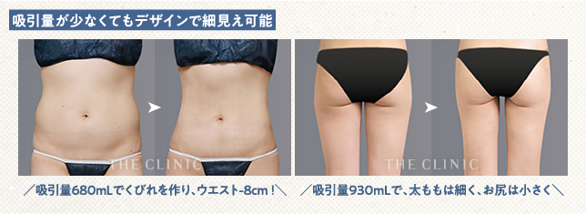 ​​吸引量680ｍLのお腹の脂肪吸引症例と、吸引量930ｍLの太もも脂肪吸引症例