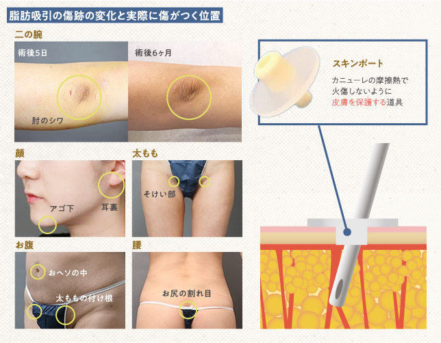 部位ごとの脂肪吸引の傷跡の位置と、施術時に皮膚をカニューレから保護するスキンポート
