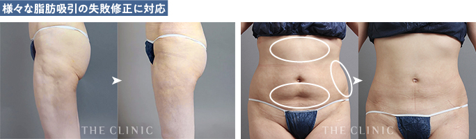 ザクリニックが対応した他院のお腹やお尻の脂肪吸引失敗の修正症例