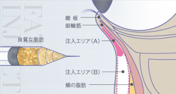 目の下のたるみ取り失敗後の修正方法