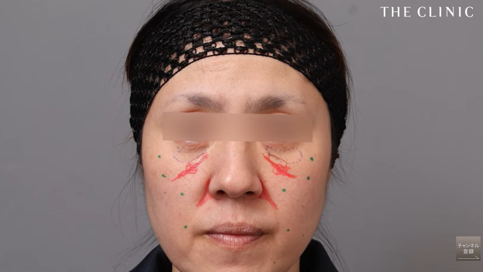 【症例①】凹みによる影とゴルゴ線、しこりのボコ付き