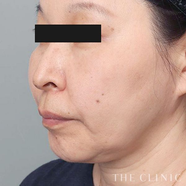 糸リフトの症例